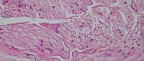 Peripheral arterial disease treatment