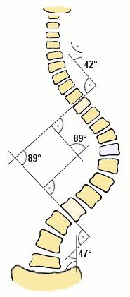 Physical therapy for spine: Scoliosis managment