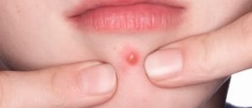How To Stop Picking At Acne