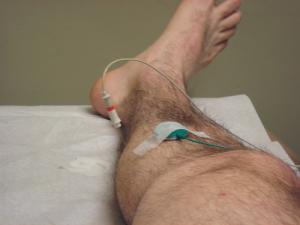 Pinched nerve in foot