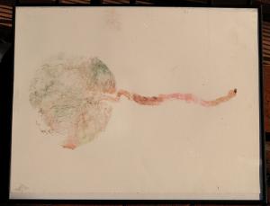 Placenta complications after birth