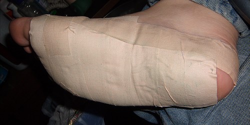 Don't Suffer With Heel Pain - It Can  Easily Be Treated