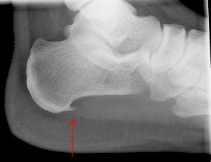 Plantar fasciitis surgery recovery
