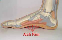 Plantar fasciitis surgery recovery time