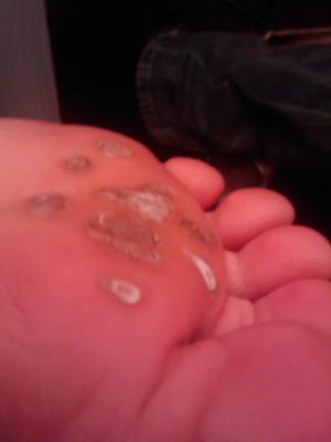 Plantar warts on feet