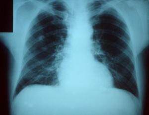 Pneumonia vaccine frequency