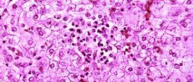 Possible causes of Reye's syndrome and correlation with aspirin