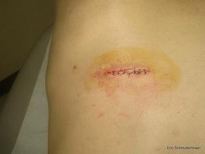 Possible complications after back surgery