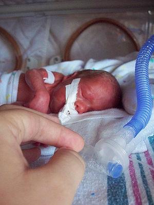 Premature babies facts