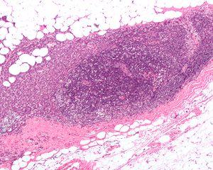 Prevention of breast cancer