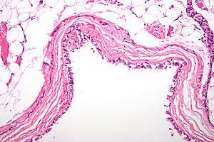 Prevention of bronchitis