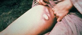 Prevention of bubonic plague