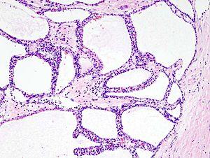 Prevention of cancer