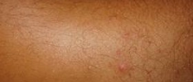 Prevention of dermatophytosis
