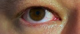 Prevention of dry eyes