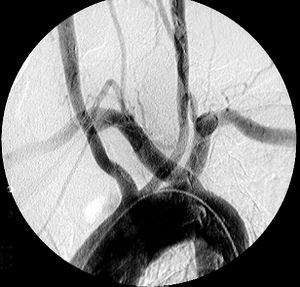 Prevention of dysphagia