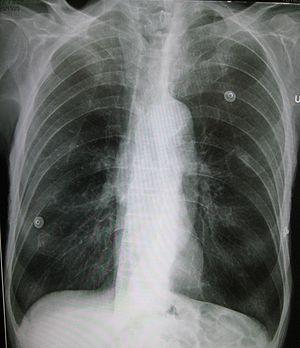 Prevention of emphysema