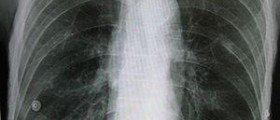 Prevention of emphysema