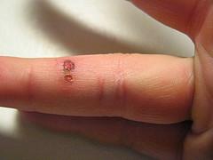 Prevention of fever blisters