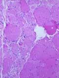 Prevention of fibromyalgia