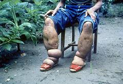 Prevention of filariasis