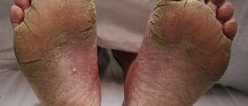 Prevention of fungus
