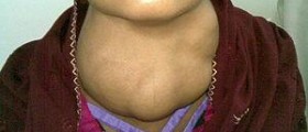 Prevention of goitre