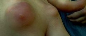 Prevention of gout