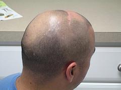 Prevention of hair loss
