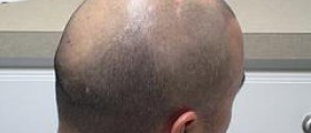 Prevention of hair loss