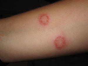 Prevention of herpes