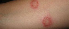 Prevention of herpes