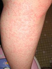 Prevention of hives