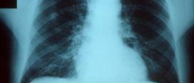 Prevention of hospital acquired pneumonia
