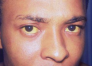 Prevention of jaundice