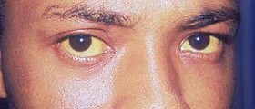 Prevention of jaundice