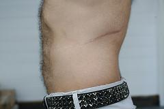 Prevention of keloids