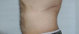 Prevention of keloids