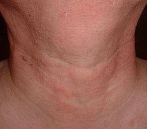 Prevention of laryngitis