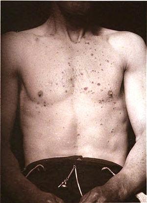 Prevention of lichen planus
