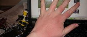 Prevention of liver spots