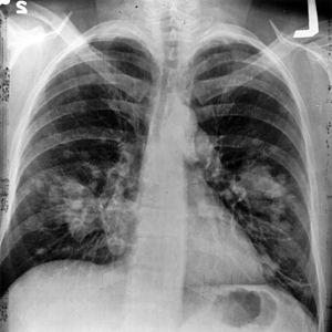 Prevention of lung cancer