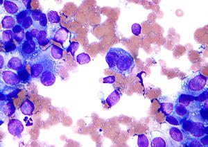 Prevention of melanoma
