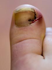 Prevention of nail fungus