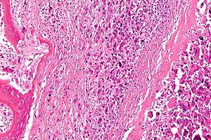 Prevention of osteoporosis in women