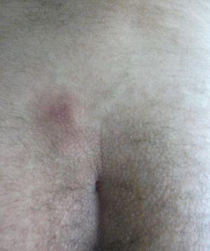 Prevention of pilonidal cysts