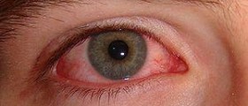 Prevention of pink eye