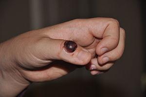Prevention of pyoderma gangrenosum