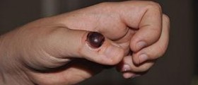 Prevention of pyoderma gangrenosum