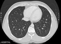 Prevention of respiratory disease